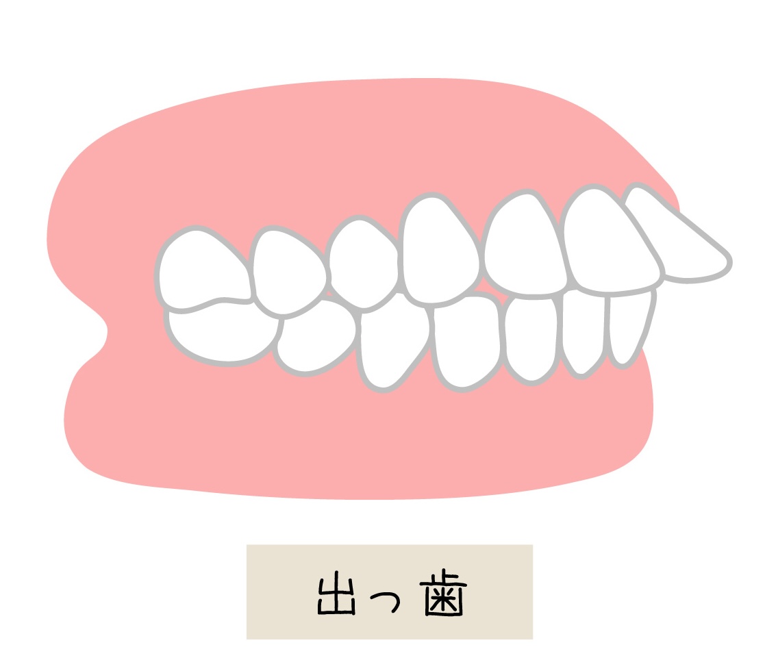 子どもの出っ歯、治療法や予防策は?