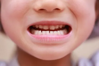 「受け口」の原因やリスク、治療方法について