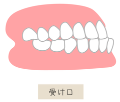 受け口