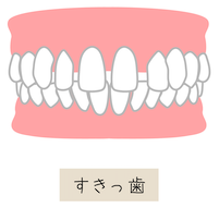 すきっ歯