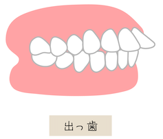 出っ歯